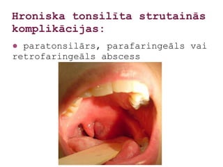 Hroniska tonsilīta strutainās
komplikācijas:
● paratonsilārs, parafaringeāls vai
retrofaringeāls abscess
 
