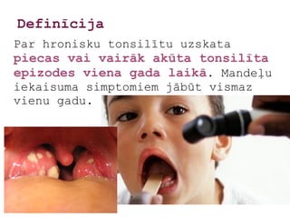 Definīcija
Par hronisku tonsilītu uzskata
piecas vai vairāk akūta tonsilīta
epizodes viena gada laikā. Mandeļu
iekaisuma simptomiem jābūt vismaz
vienu gadu.
 