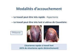 Modalités d’accouchement
– Le travail peut être très rapide : Hypertonie
– Le travail peut être très lent si utérus de Couvelaire:
Atonie
Césarienne rapide si travail lent
(41% de césarienne après déclenchement)
Césarienne rapide si travail lent
(41% de césarienne après déclenchement)
 