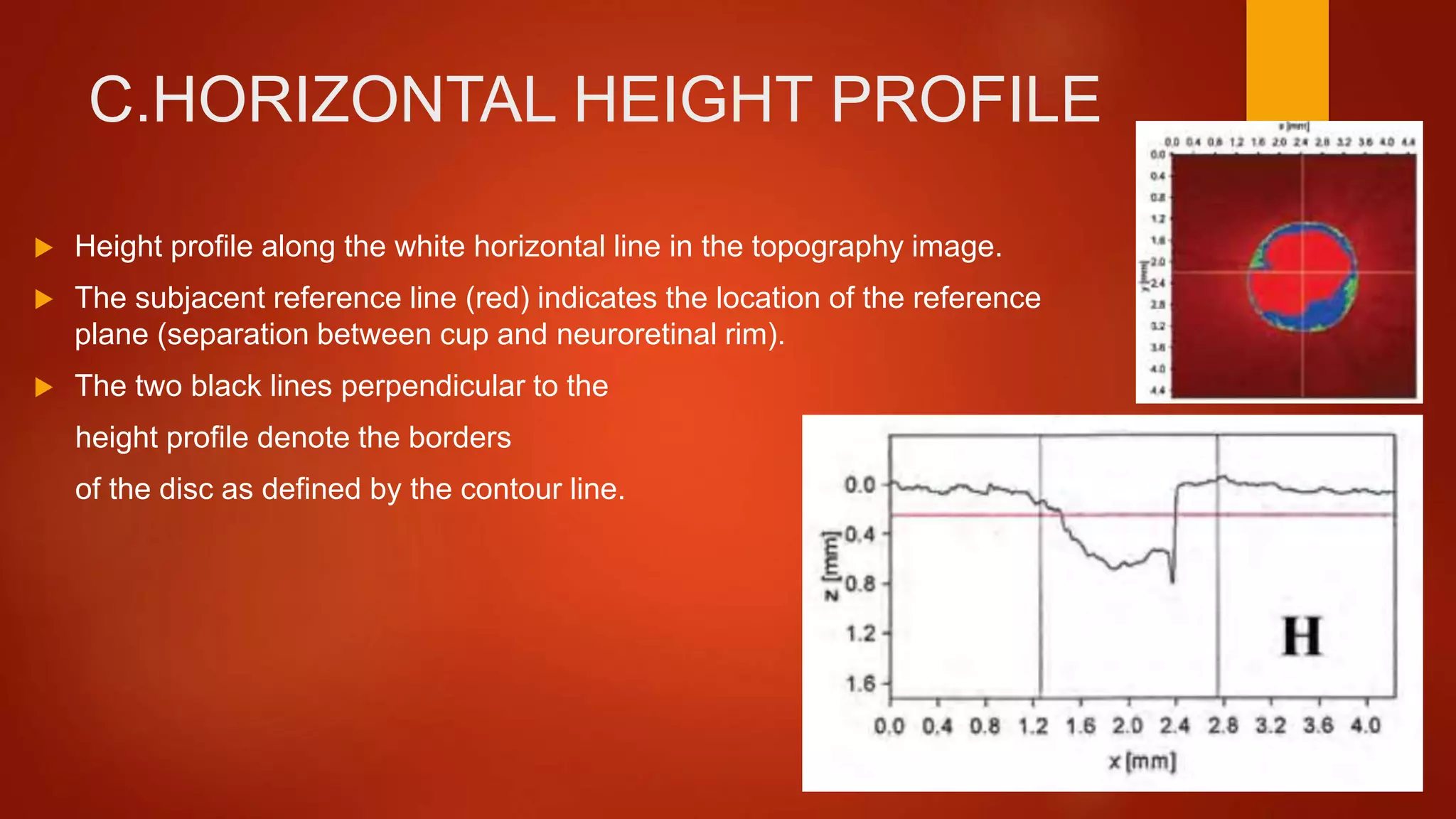 C.HORIZONTAL HEIGHT PROFILE
 Height profile along the white horizontal line in the topography image.
 The subjacent reference line (red) indicates the location of the reference
plane (separation between cup and neuroretinal rim).
 The two black lines perpendicular to the
height profile denote the borders
of the disc as defined by the contour line.
 