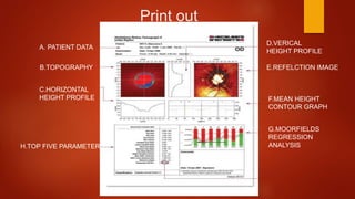 Print out
A. PATIENT DATA
B.TOPOGRAPHY
C.HORIZONTAL
HEIGHT PROFILE
D.VERICAL
HEIGHT PROFILE
E.REFELCTION IMAGE
H.TOP FIVE PARAMETERS
F.MEAN HEIGHT
CONTOUR GRAPH
G.MOORFIELDS
REGRESSION
ANALYSIS
 