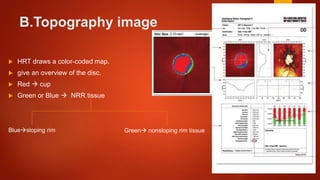 B.Topography image
 HRT draws a color-coded map.
 give an overview of the disc.
 Red  cup
 Green or Blue  NRR tissue
Bluesloping rim Green nonsloping rim tissue
 