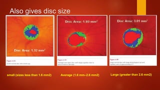 Also gives disc size
small (sizes less than 1.6 mm2) Average (1.6 mm–2.6 mm2) Large (greater than 2.6 mm2)
 
