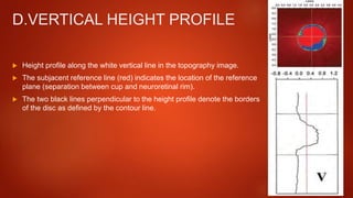 D.VERTICAL HEIGHT PROFILE
 Height profile along the white vertical line in the topography image.
 The subjacent reference line (red) indicates the location of the reference
plane (separation between cup and neuroretinal rim).
 The two black lines perpendicular to the height profile denote the borders
of the disc as defined by the contour line.
 