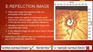 E.REFELCTION IMAGE
 False-color image that appears similar to a
photograph of the optic disc
 Darker areas are regions of decreased overall
reflectance, whereas lighter areas, such as the base
of the cup, are areas of the greatest reflectance
 Valuable in locating and drawing the contour line
around the disc margin
 In the reflection image the optic nerve head is divided
into 6 sectors.
 Depending on this patient’s age and overall disc size the
eye is then statistically classified as.
 