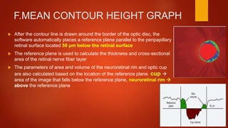 F.MEAN CONTOUR HEIGHT GRAPH
 After the contour line is drawn around the border of the optic disc, the
software automatically places a reference plane parallel to the peripapillary
retinal surface located 50 μm below the retinal surface
 The reference plane is used to calculate the thickness and cross-sectional
area of the retinal nerve fiber layer
 The parameters of area and volume of the neuroretinal rim and optic cup
are also calculated based on the location of the reference plane. cup 
area of the image that falls below the reference plane, neuroretinal rim 
above the reference plane
 