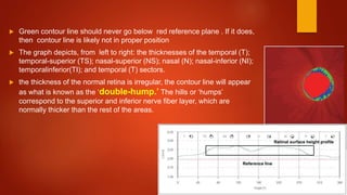  Green contour line should never go below red reference plane . If it does,
then contour line is likely not in proper position
 The graph depicts, from left to right: the thicknesses of the temporal (T);
temporal-superior (TS); nasal-superior (NS); nasal (N); nasal-inferior (NI);
temporalinferior(TI); and temporal (T) sectors.
 the thickness of the normal retina is irregular, the contour line will appear
as what is known as the ‘double-hump.’ The hills or ‘humps’
correspond to the superior and inferior nerve fiber layer, which are
normally thicker than the rest of the areas.
Reference line
Retinal surface height profile
 