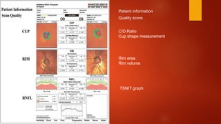 Patient information
Quality score
C/D Ratio
Cup shape measurement
Rim area
Rim volume
TSNIT graph
 
