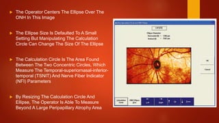  The Operator Centers The Ellipse Over The
ONH In This Image
 The Ellipse Size Is Defaulted To A Small
Setting But Manipulating The Calculation
Circle Can Change The Size Of The Ellipse
 The Calculation Circle Is The Area Found
Between The Two Concentric Circles, Which
Measure The Temporal-superiornasal-inferior-
temporal (TSNIT) And Nerve Fiber Indicator
(NFI) Parameters
 By Resizing The Calculation Circle And
Ellipse, The Operator Is Able To Measure
Beyond A Large Peripapillary Atrophy Area
 
