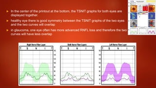  In the center of the printout at the bottom, the TSNIT graphs for both eyes are
displayed together.
 healthy eye there is good symmetry between the TSNIT graphs of the two eyes
and the two curves will overlap
 in glaucoma, one eye often has more advanced RNFL loss and therefore the two
curves will have less overlap
 