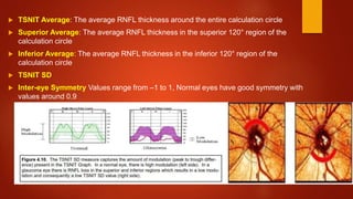  TSNIT Average: The average RNFL thickness around the entire calculation circle
 Superior Average: The average RNFL thickness in the superior 120° region of the
calculation circle
 Inferior Average: The average RNFL thickness in the inferior 120° region of the
calculation circle
 TSNIT SD
 Inter-eye Symmetry Values range from –1 to 1, Normal eyes have good symmetry with
values around 0.9
 