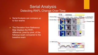 Serial Analysis
Detecting RNFL Change Over Time
 Serial Analysis can compare up
to four exams
 The Deviation from Reference
Map displays the RNFL
difference, pixel by pixel, of the
followup exam compared to the
baseline exam
 