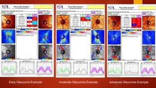 Early Glaucoma Example moderate Glaucoma Example advanced Glaucoma Example
 