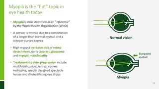 Myopia is the “hot” topic in
eye health today
• Myopia is now identified as an “epidemic”
by the World Health Organization (WHO)
• A person is myopic due to a combination
of a longer than normal eyeball and a
steeper curved cornea
• High myopia increases risk of retina
detachment, early cataract, glaucoma
and myopic maculopathy
• Treatments to slow progression include
multifocal contact lenses, cornea
reshaping, special designed spectacle
lenses and dilute dilating eye drops
Normal vision
Myopia
Elongated
eyeball
| 22
 