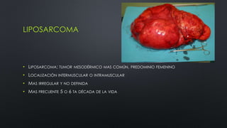LIPOSARCOMA 
• LIPOSARCOMA: TUMOR MESODÉRMICO MAS COMÚN, PREDOMINIO FEMENINO 
• LOCALIZACIÓN INTERMUSCULAR O INTRAMUSCULAR 
• MAS IRREGULAR Y NO DEFINIDA 
• MAS FRECUENTE 5 O 6 TA DÉCADA DE LA VIDA 
 
