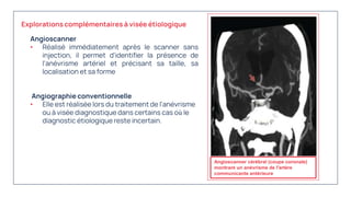 Angioscanner
• Réalisé immédiatement après le scanner sans
injection, il permet d'identifier la présence de
l'anévrisme artériel et précisant sa taille, sa
localisation et sa forme
Angiographie conventionnelle
• Elle est réalisée lors du traitement de l'anévrisme
ou à visée diagnostique dans certains cas où le
diagnostic étiologique reste incertain.
Angioscanner cérébral (coupe coronale)
montrant un anévrisme de l'artère
communicante antérieure
Explorations complémentaires à visée étiologique
 