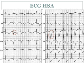 ECG HSA
 