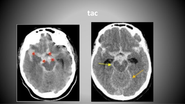 Hsa Por Aneurisma Cerebral Roto Final