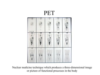 PET  Nuclear medicine technique which produces a three-dimensional image or picture of functional processes in the body 
