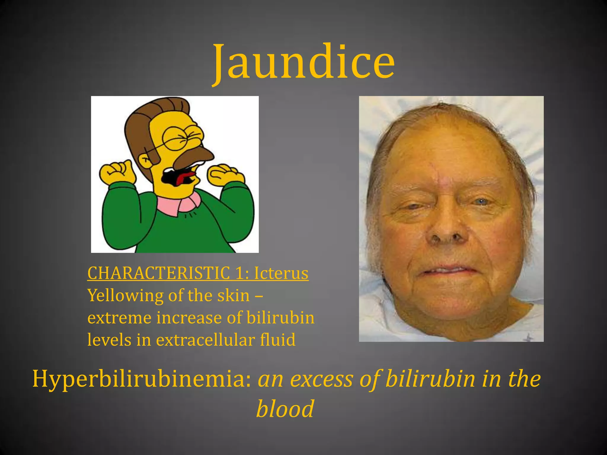 JaundiceCHARACTERISTIC 1: IcterusYellowing of the skin– extreme increase of bilirubin levels in extracellular fluidHyperbilirubinemia: an excess of bilirubin in the blood