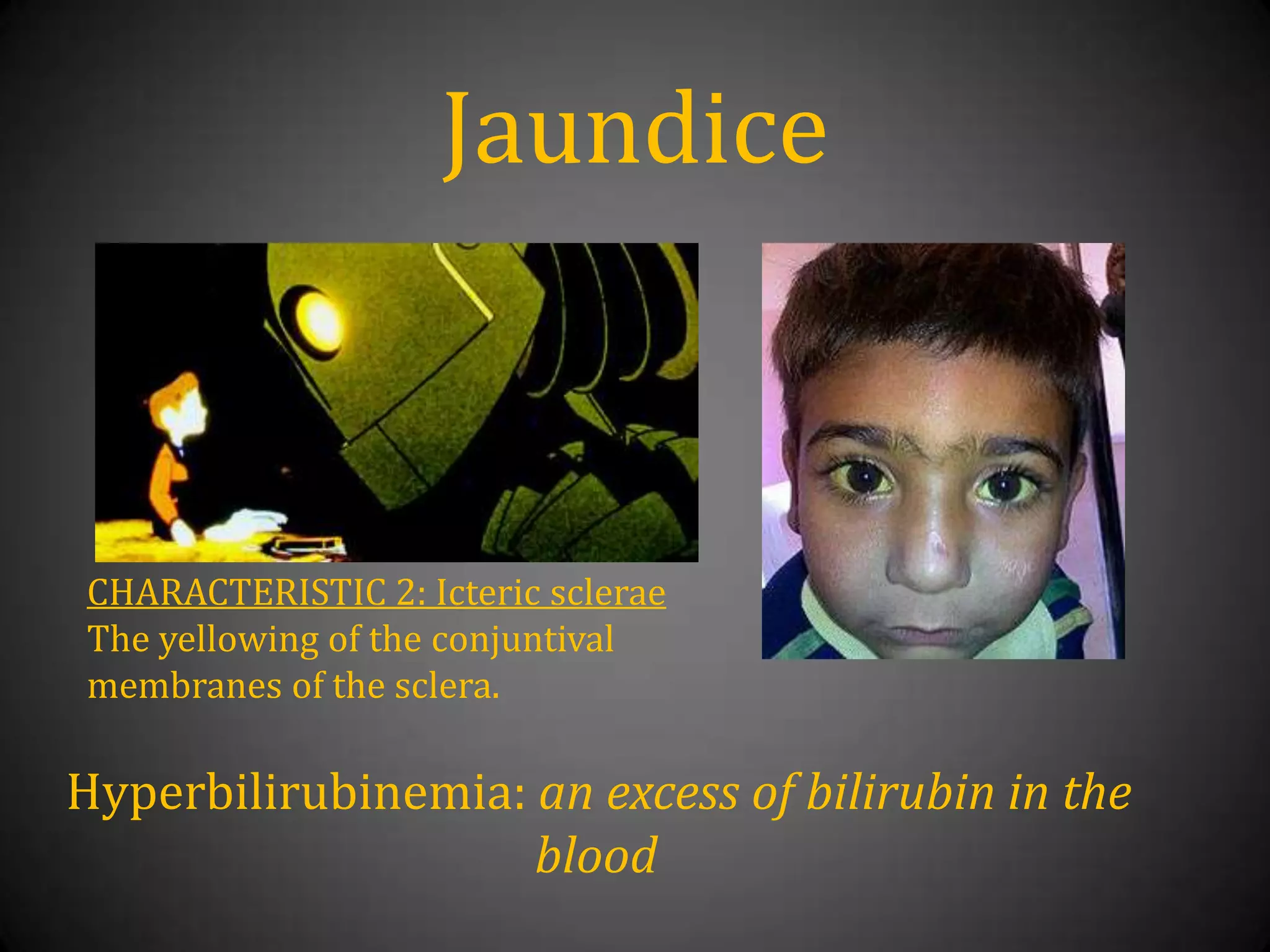 JaundiceCHARACTERISTIC 2: IctericscleraeThe yellowing of the conjuntival membranes of the sclera.Hyperbilirubinemia: an excess of bilirubin in the blood