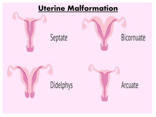 Uterine Malformation
 