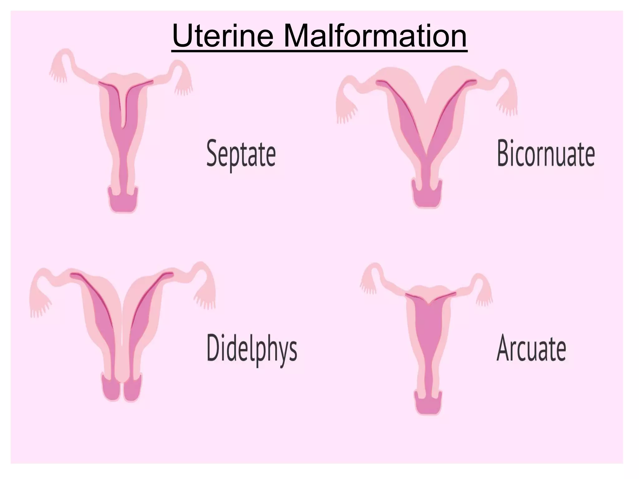 Uterine Malformation