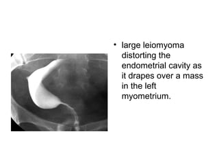 • large leiomyoma
distorting the
endometrial cavity as
it drapes over a mass
in the left
myometrium.
 