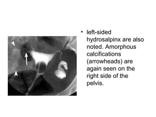 • left-sided
hydrosalpinx are also
noted. Amorphous
calcifications
(arrowheads) are
again seen on the
right side of the
pelvis.
 