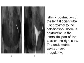 • isthmic obstruction of
the left fallopian tube
just proximal to the
calcification. There is
obstruction in the
interstitial part of the
tube on the right side.
The endometrial
cavity shows
irregularity.
 