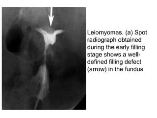 • Leiomyomas. (a) Spot
radiograph obtained
during the early filling
stage shows a well-
defined filling defect
(arrow) in the fundus
 