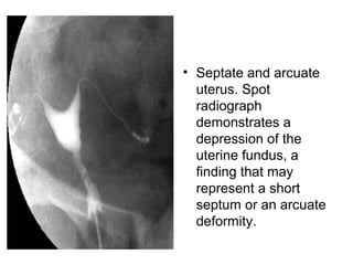 • Septate and arcuate
uterus. Spot
radiograph
demonstrates a
depression of the
uterine fundus, a
finding that may
represent a short
septum or an arcuate
deformity.
 