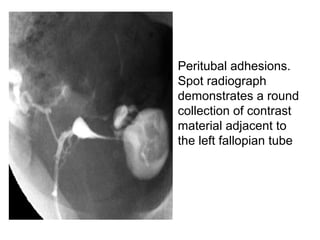 • Peritubal adhesions.
Spot radiograph
demonstrates a round
collection of contrast
material adjacent to
the left fallopian tube
 