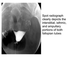 • Spot radiograph
clearly depicts the
interstitial, isthmic,
and ampullary
portions of both
fallopian tubes
 