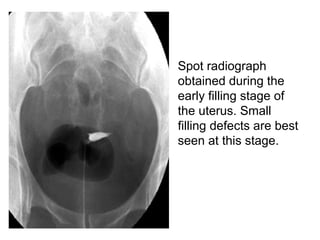 • Spot radiograph
obtained during the
early filling stage of
the uterus. Small
filling defects are best
seen at this stage.
 