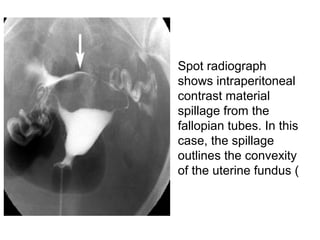 • Spot radiograph
shows intraperitoneal
contrast material
spillage from the
fallopian tubes. In this
case, the spillage
outlines the convexity
of the uterine fundus (
 