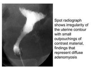 • Spot radiograph
shows irregularity of
the uterine contour
with small
outpouchings of
contrast material,
findings that
represent diffuse
adenomyosis
 