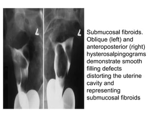 • Submucosal fibroids.
Oblique (left) and
anteroposterior (right)
hysterosalpingograms
demonstrate smooth
filling defects
distorting the uterine
cavity and
representing
submucosal fibroids
 