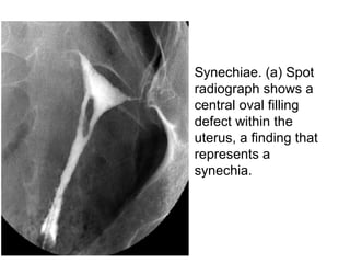 • Synechiae. (a) Spot
radiograph shows a
central oval filling
defect within the
uterus, a finding that
represents a
synechia.
 