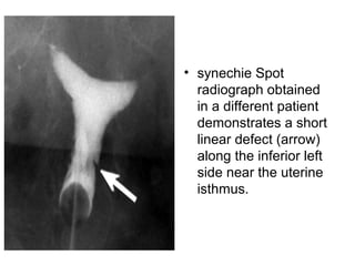• synechie Spot
radiograph obtained
in a different patient
demonstrates a short
linear defect (arrow)
along the inferior left
side near the uterine
isthmus.
 