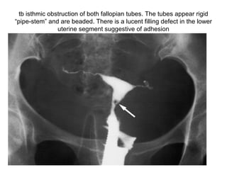 tb isthmic obstruction of both fallopian tubes. The tubes appear rigid
“pipe-stem” and are beaded. There is a lucent filling defect in the lower
uterine segment suggestive of adhesion
 