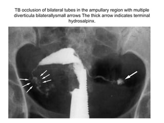 TB occlusion of bilateral tubes in the ampullary region with multiple
diverticula bilaterallysmall arrows The thick arrow indicates terminal
hydrosalpinx.
 