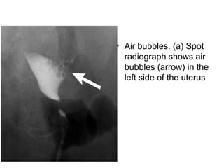 • Air bubbles. (a) Spot
radiograph shows air
bubbles (arrow) in the
left side of the uterus
 