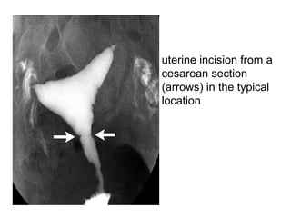 • uterine incision from a
cesarean section
(arrows) in the typical
location
 