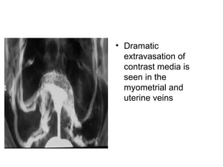 • Dramatic
extravasation of
contrast media is
seen in the
myometrial and
uterine veins
 