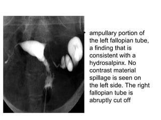 • ampullary portion of
the left fallopian tube,
a finding that is
consistent with a
hydrosalpinx. No
contrast material
spillage is seen on
the left side. The right
fallopian tube is
abruptly cut off
 