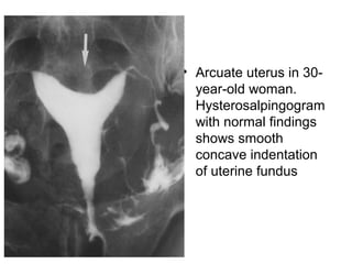 • Arcuate uterus in 30-
year-old woman.
Hysterosalpingogram
with normal findings
shows smooth
concave indentation
of uterine fundus
 