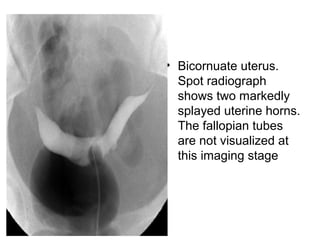 • Bicornuate uterus.
Spot radiograph
shows two markedly
splayed uterine horns.
The fallopian tubes
are not visualized at
this imaging stage
 