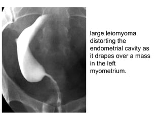 • large leiomyoma
distorting the
endometrial cavity as
it drapes over a mass
in the left
myometrium.
 