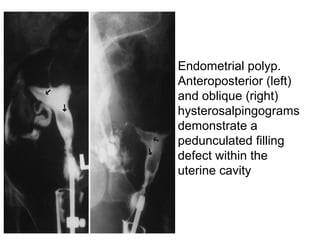 • Endometrial polyp.
Anteroposterior (left)
and oblique (right)
hysterosalpingograms
demonstrate a
pedunculated filling
defect within the
uterine cavity
 